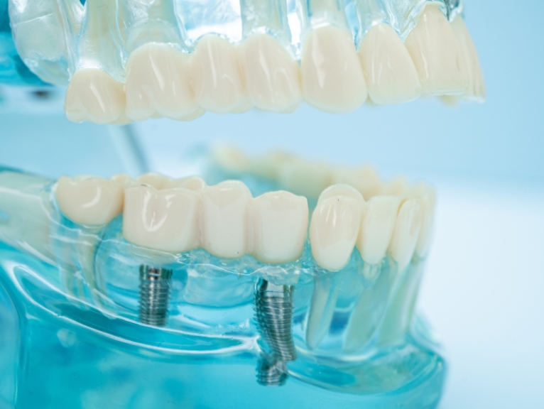 hydrophilic technology: Close-up of dental implants and prosthetic teeth mounted on a transparent model demonstrating dental materials