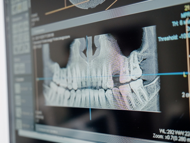 Digital dentistry for dental practices: Close-up of a panoramic dental X-ray displayed on a computer screen