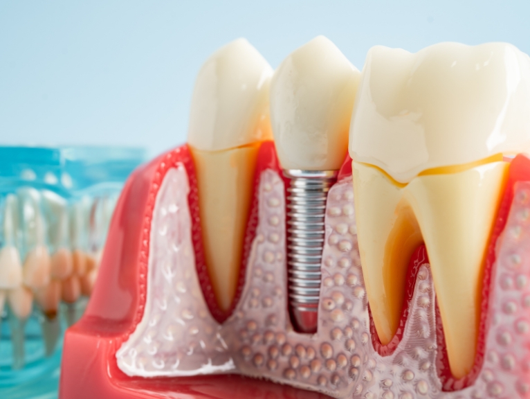 Dental Implant Systems: Close-up model showing a dental implant screw placed into the jawbone between natural teeth.